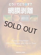 どう診てどう治す?網膜剥離 どう診てどう治す?網膜剥離⁄平形明人⁄井上真 どう診てどう